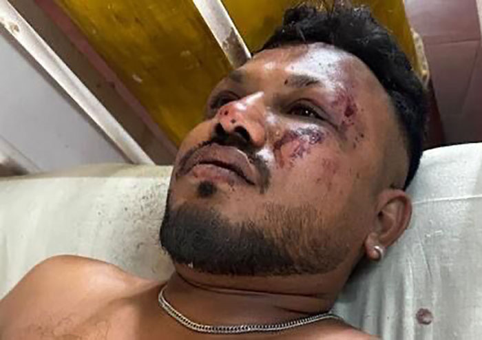 Lone survivor of Air India crash with facial injuries resting on a hospital bed after the flight's final moments.