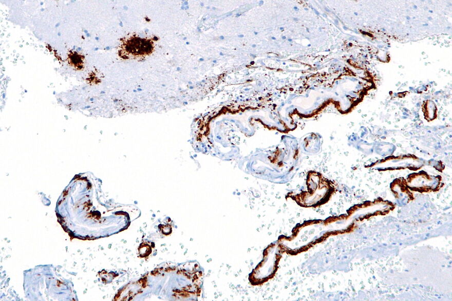 Microscopic view of brain tissue with stained amyloid plaques related to Alzheimer's research and pharmaceutical studies.