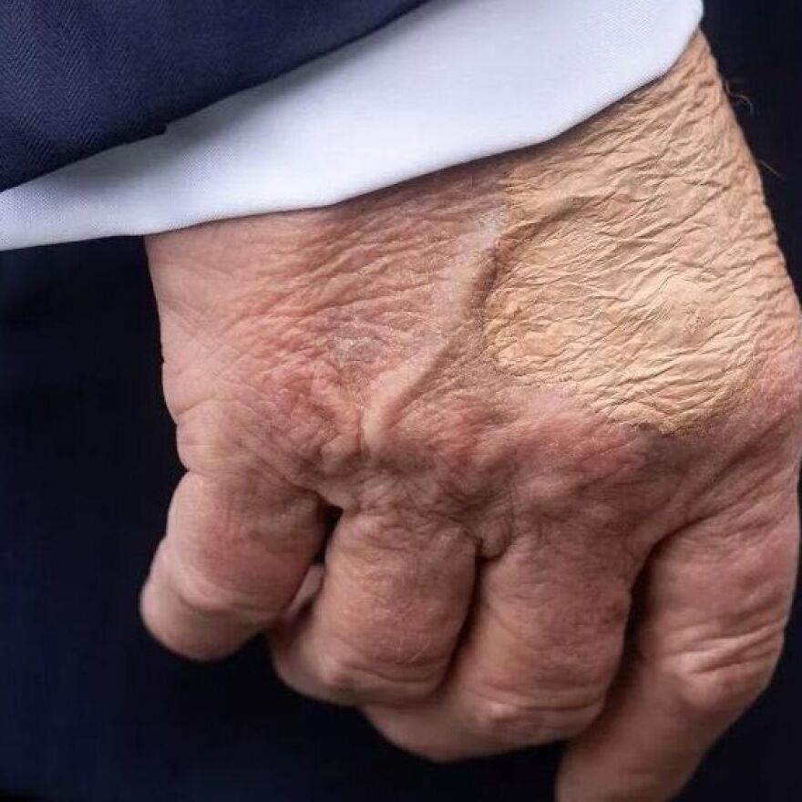 Close-up of a hand showing skin texture and bizarre marks on Trump&rsquo;s body under natural light.