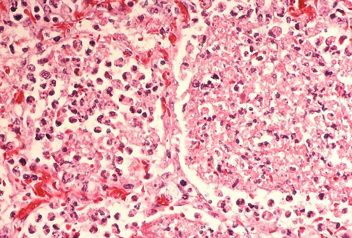 Microscopic view of lung tissue showing infection cells linked to Legionnaires disease outbreak in New York City.