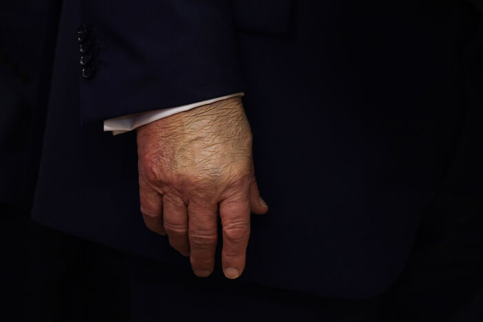 Close-up of an older man&rsquo;s hand with visible veins, wearing a dark suit, highlighting health issues and compression socks.