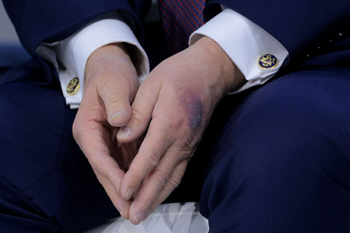Close-up of Donald Trump&rsquo;s hands showing a visible bruise, captured during the Davos event.